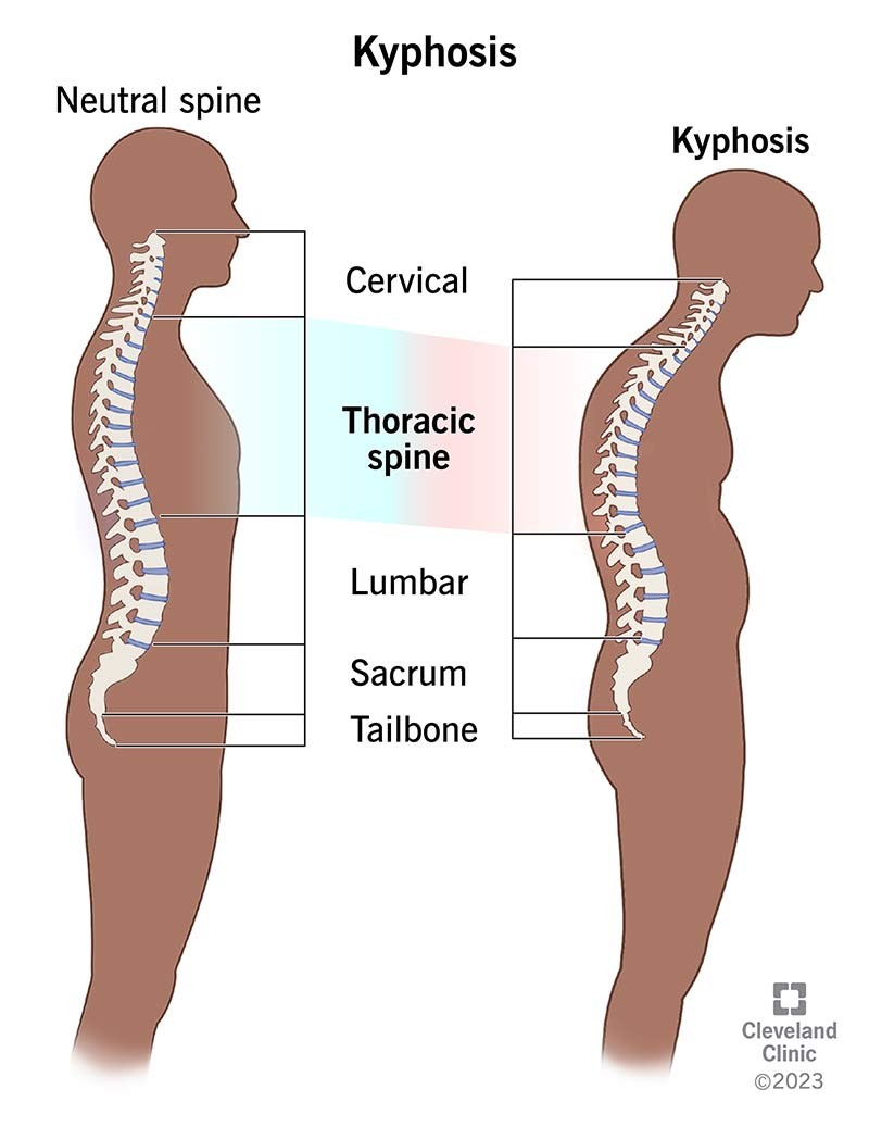 spinal slippage